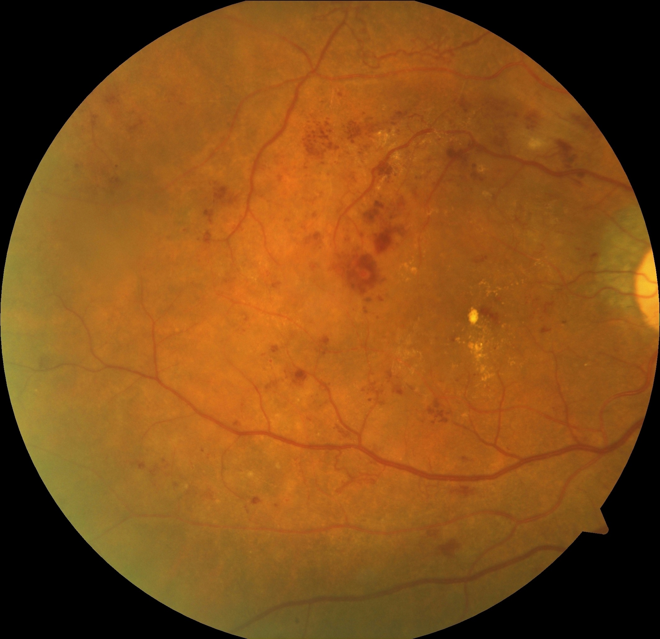 Замена сетчатки. Атеросклеротическая ретинопатия. Эпиретинальная мембрана. Наружная экссудативная ретинопатия. Вителиформная дистрофия макулы.